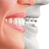 invisalign-bracket